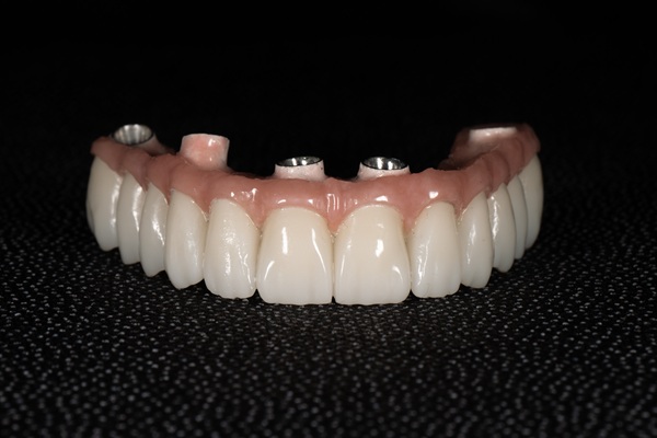 How Effective Are All On X Implants Compared To Traditional Dentures?