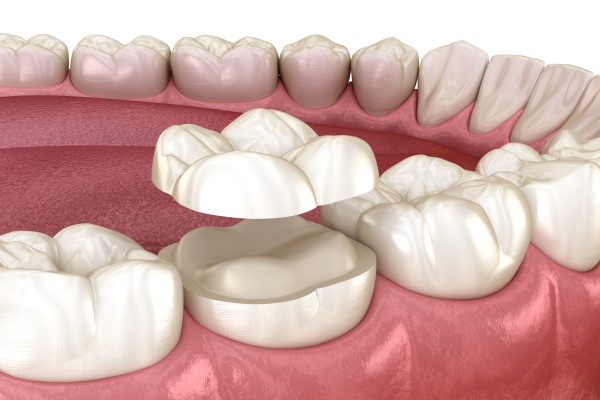Dental Onlays Vs  Crowns: Which Is The Best Option For You?